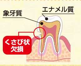 くさび状欠損:WSD|中野の歯医者 | マナミ歯科クリニック